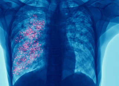 Cáncer de pulmón: detección temprana para reducir mortalidad